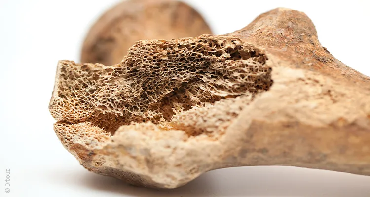 Nahaufnahme eines gesplitterten Knochens, sodass die poröse Struktur zu sehen ist.